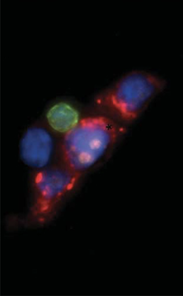 Circulating tumor cells - prostate